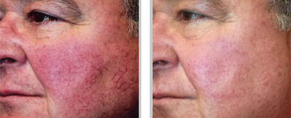 Rosacea treatment with BBL at The MW Clinic London